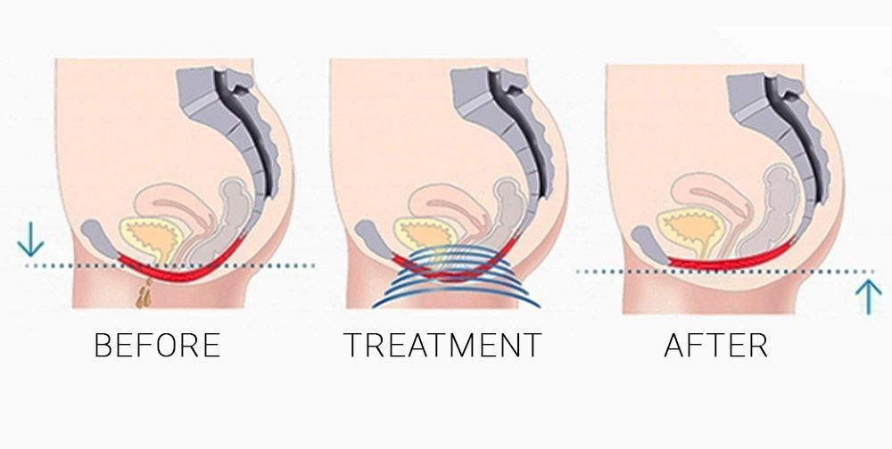 https://hyperfitmd.com/wp-content/uploads/2022/11/btl-emsella-before-and-after-graphic-urinary-incontinence-pelvic-floor-treatment.jpg?x21933